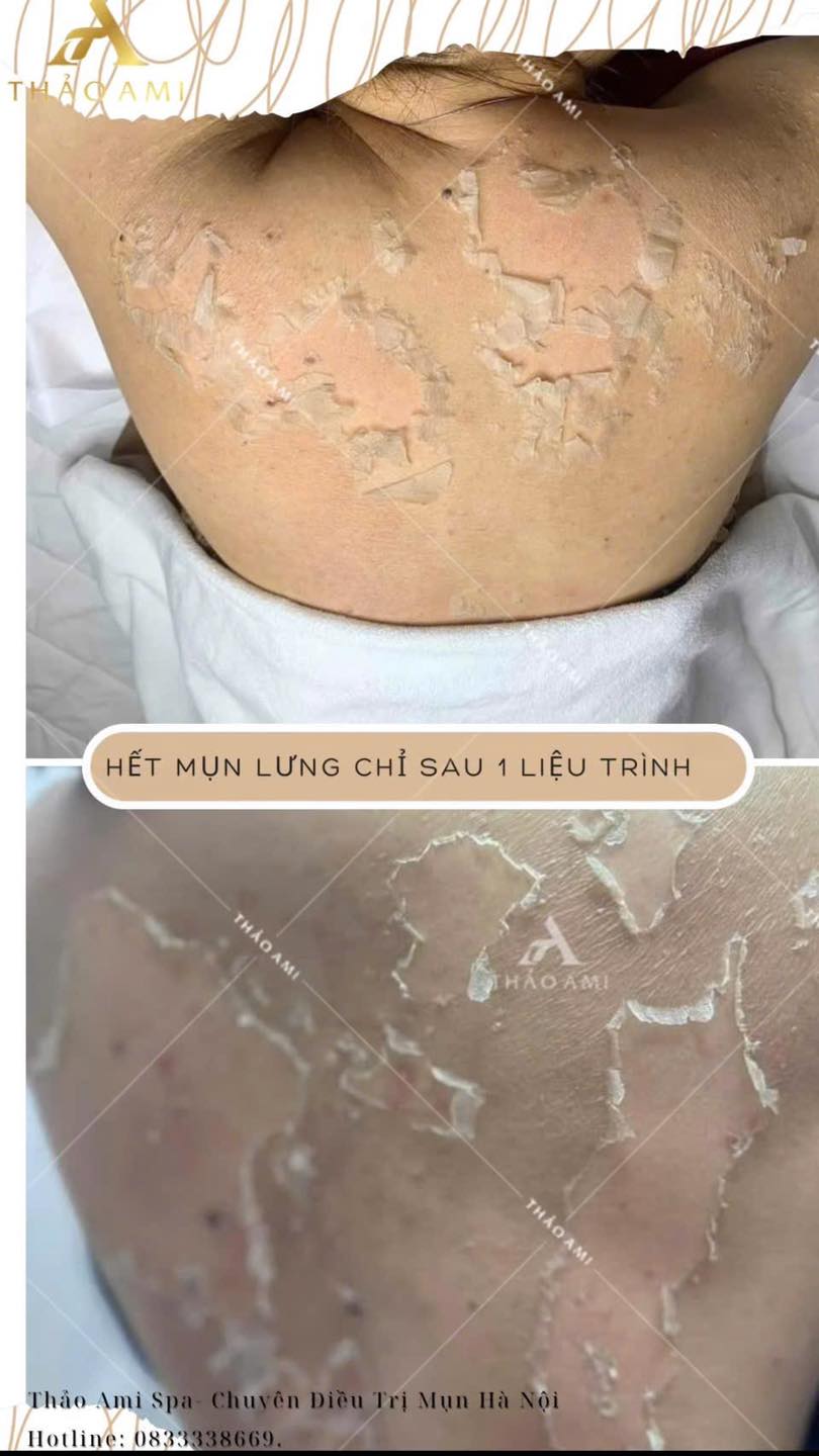 mụn lưng 1 liệu trình peel da