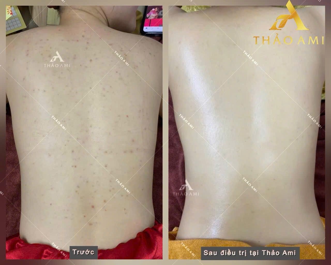 mụn lưng sau điều trị