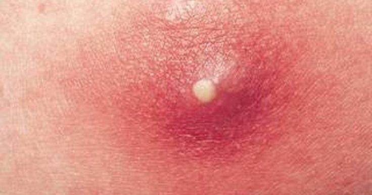 mụn nhọt ở mông