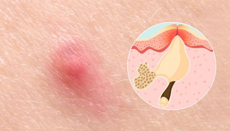 mụn nhọt ở mông