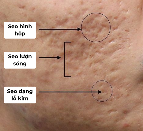 Các hình dạng sẹo rỗ