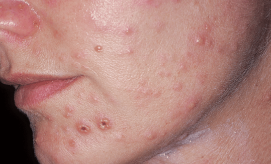 Sẹo do thuỷ đậu