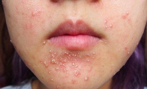 Mụn nhỏ li ti quanh miệng