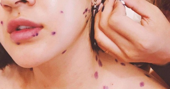 Sẹo lõm do thuỷ đậu