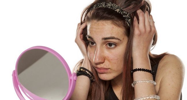 Sẹo rỗ tuổi dậy thì