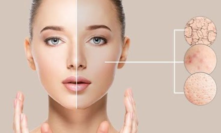 trị sẹo rỗ hiệu quả