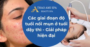 Các giai đoạn độ tuổi nổi mụn ở tuổi dậy thì - Giải pháp hiện đại