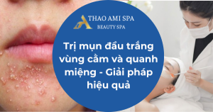Trị mụn đầu trắng vùng cằm và quanh miệng - Giải pháp hiệu quả