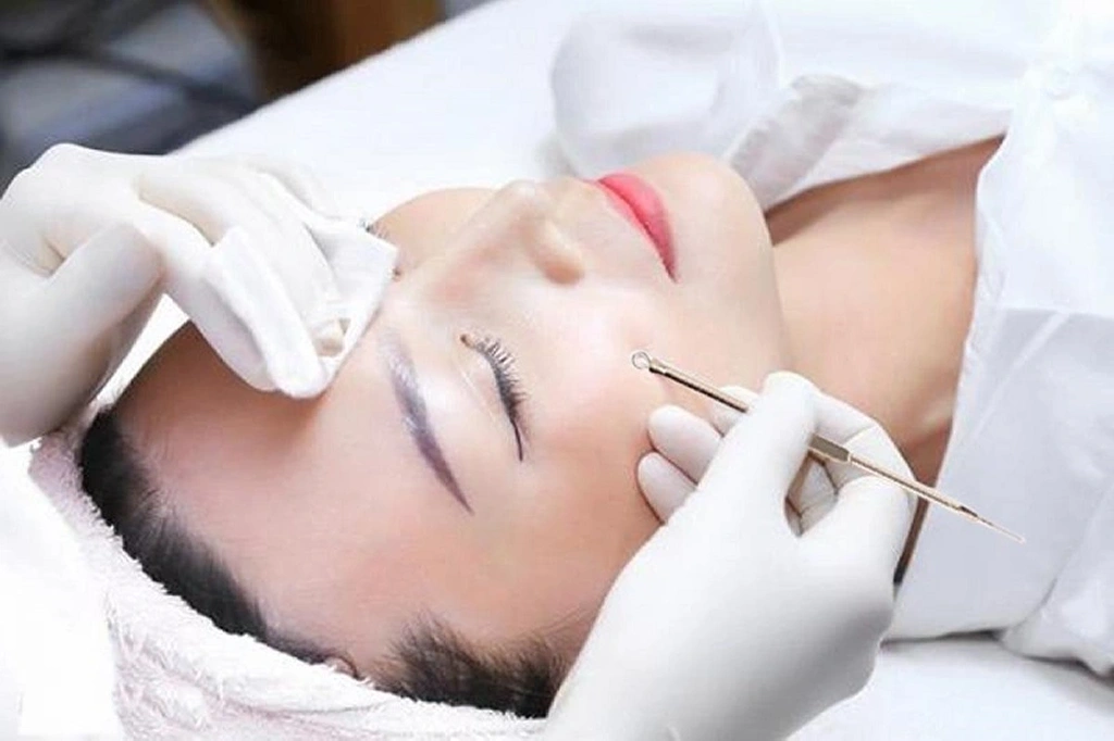 Lấy nhân mụn y khoa