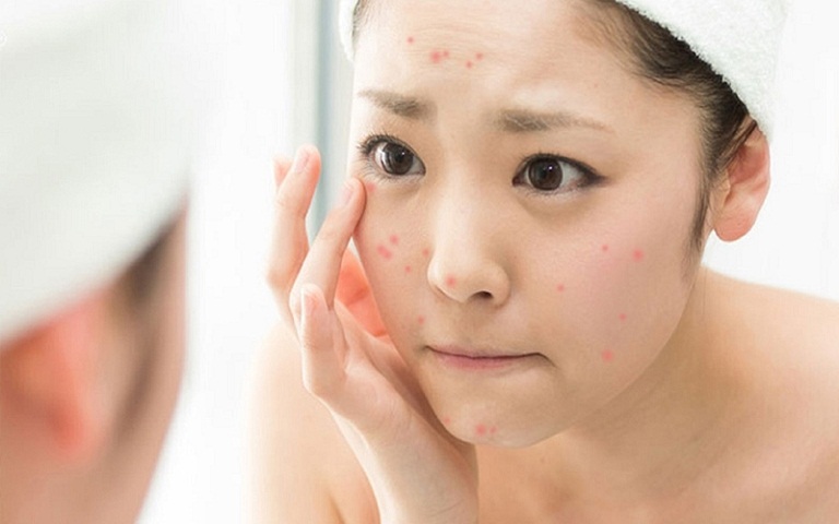 Cách trị mụn ở tuổi dậy thì