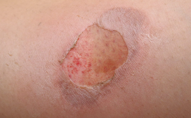 Cách trị bỏng bô hiệu quả