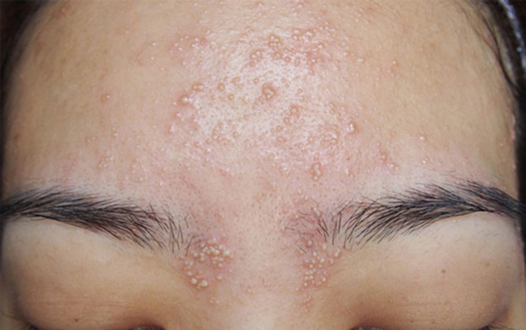 Da mặt nổi mụn nước
