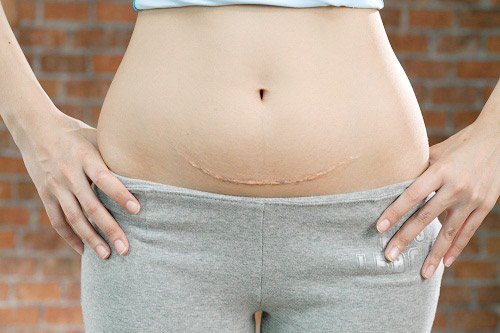 Điều trị sẹo sau sinh mố