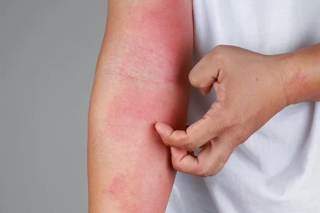 Điều trị thâm do gãi ngứa