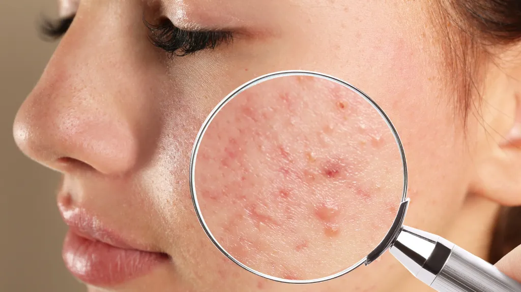 Giai đoạn nổi mụn tuổi dậy thì