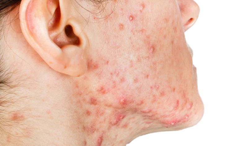 Mụn mủ gây viêm sẹo