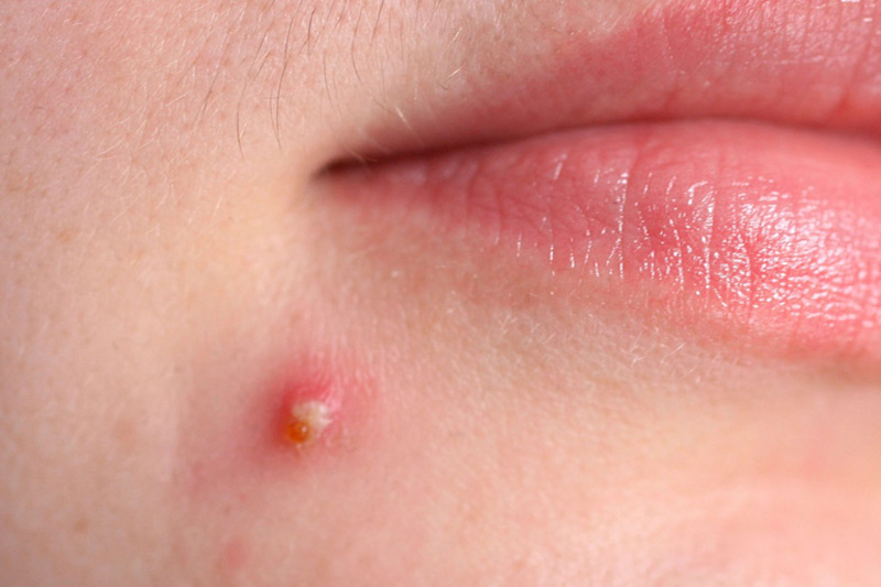 Mụn mủ là gì