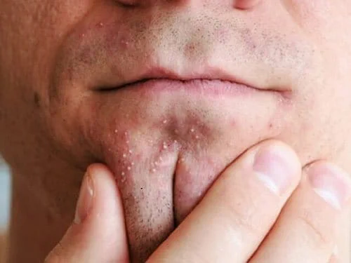 Nguyên nhân mụn đầu trắng quanh miệng và cằm
