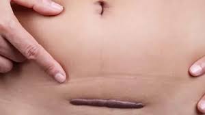 Sẹo sau sinh mổ