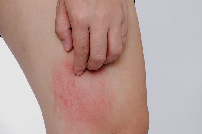 Trị sẹo thâm do gãi ngứa