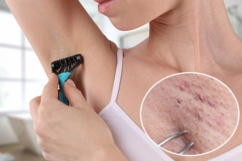 Điều trị thâm nách do cạo nhổ