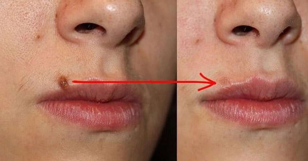 Sẹo đỏ sau khi phá nốt ruồi