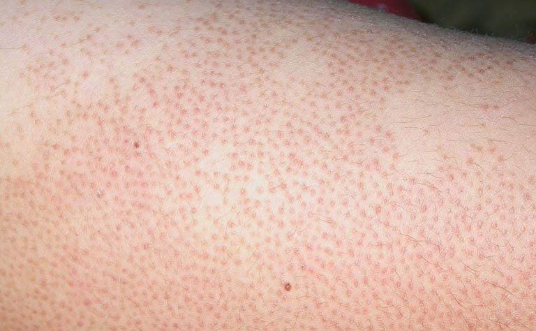 Viêm lỗ chân lông